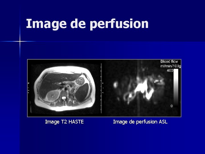 Image de perfusion Image T 2 HASTE Image de perfusion ASL 