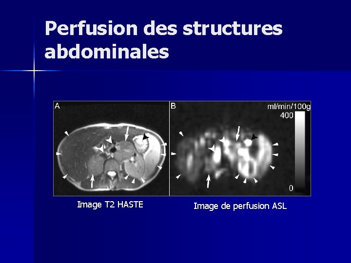 Perfusion des structures abdominales Image T 2 HASTE Image de perfusion ASL 