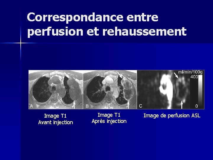 Correspondance entre perfusion et rehaussement Image T 1 Avant injection Image T 1 Après