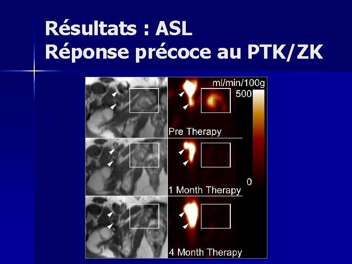 Résultats : ASL Réponse précoce au PTK/ZK 