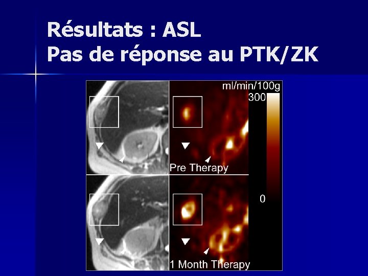 Résultats : ASL Pas de réponse au PTK/ZK 