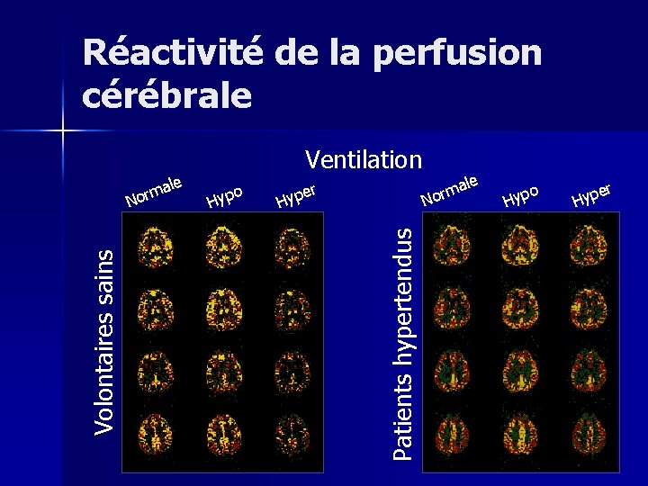 Réactivité de la perfusion cérébrale o Hyp er Hyp Patients hypertendus Volontaires sains ale