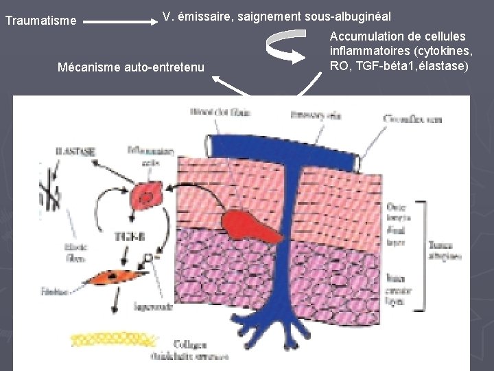 Traumatisme V. émissaire, saignement sous-albuginéal Mécanisme auto-entretenu Accumulation de cellules inflammatoires (cytokines, RO, TGF-béta