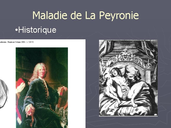 Maladie de La Peyronie • Historique 