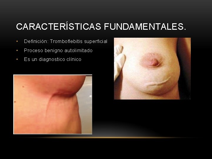 CARACTERÍSTICAS FUNDAMENTALES. • Definición: Tromboflebitis superficial • Proceso benigno autolimitado • Es un diagnostico