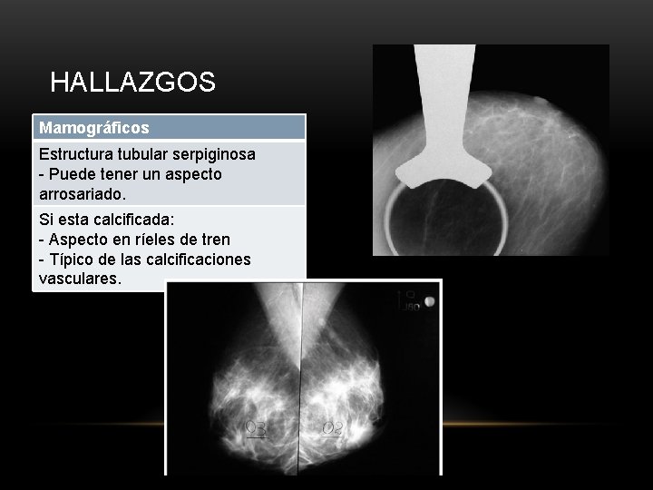 HALLAZGOS Mamográficos Estructura tubular serpiginosa - Puede tener un aspecto arrosariado. Si esta calcificada: