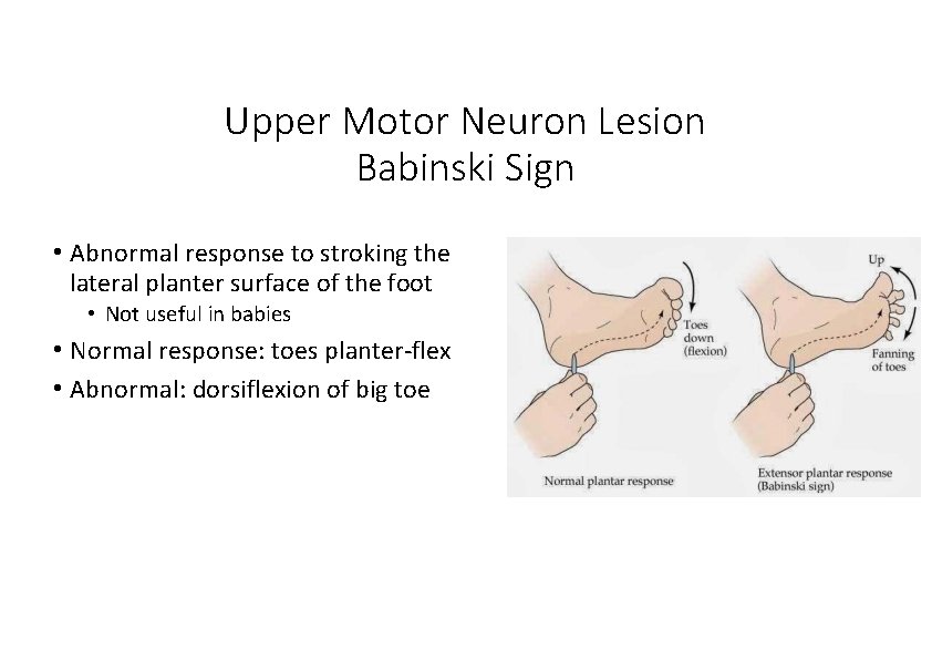 Upper Motor Neuron Lesion Babinski Sign • Abnormal response to stroking the lateral planter