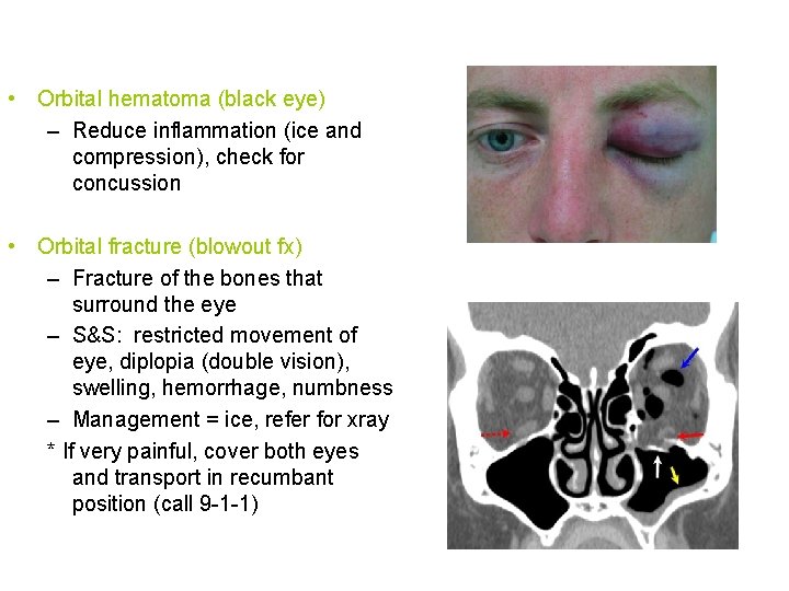  • Orbital hematoma (black eye) – Reduce inflammation (ice and compression), check for