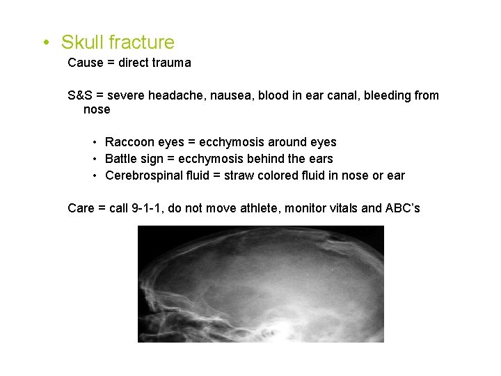  • Skull fracture Cause = direct trauma S&S = severe headache, nausea, blood