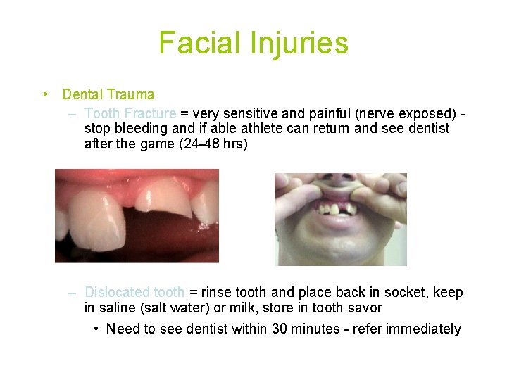 Facial Injuries • Dental Trauma – Tooth Fracture = very sensitive and painful (nerve