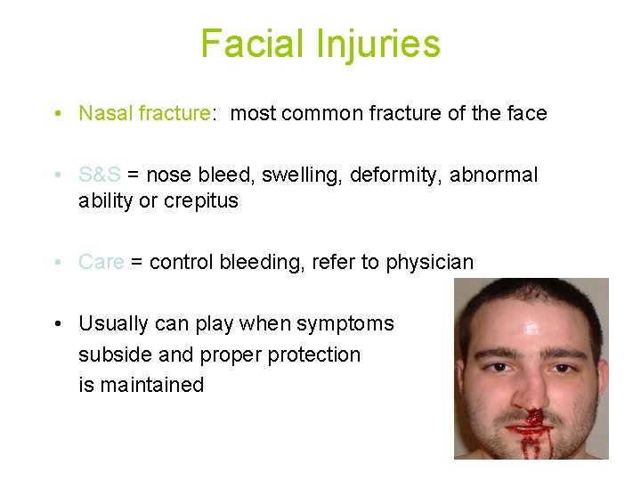Facial Injuries • Nasal fracture: most common fracture of the face • S&S =