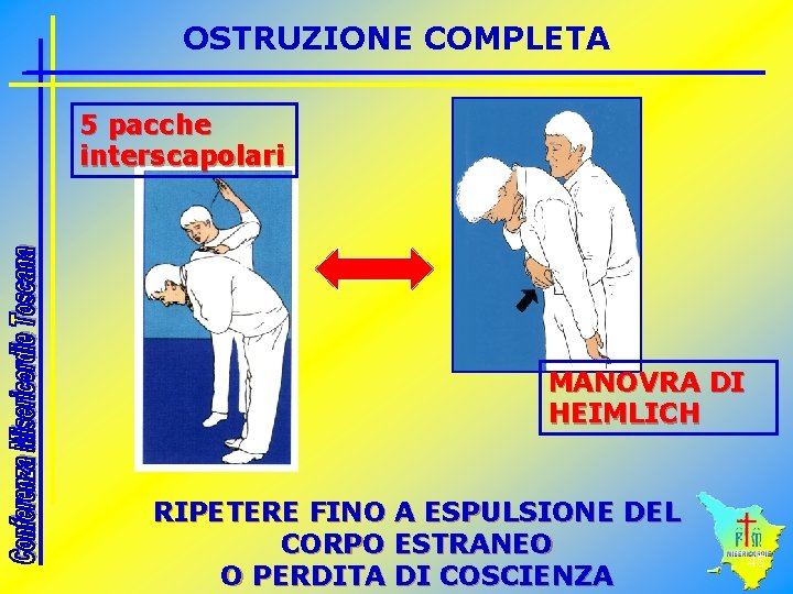 OSTRUZIONE COMPLETA 5 pacche interscapolari MANOVRA DI HEIMLICH RIPETERE FINO A ESPULSIONE DEL CORPO