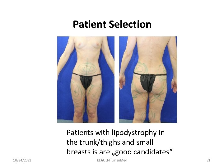 Patient Selection Patients with lipodystrophy in the trunk/thighs and small breasts is are „good