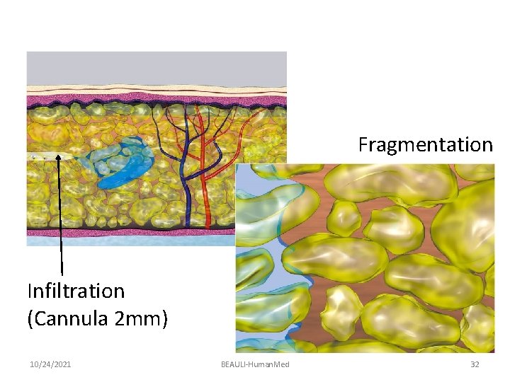 Fragmentation Infiltration (Cannula 2 mm) 10/24/2021 BEAULI-Human. Med 32 