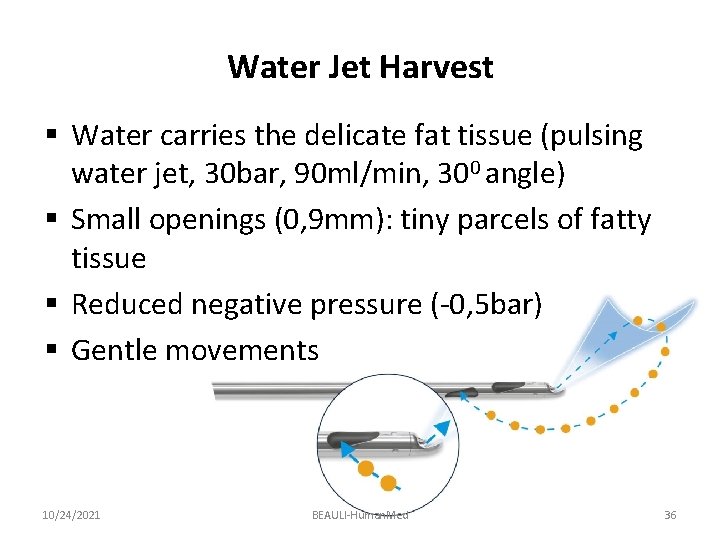 Water Jet Harvest § Water carries the delicate fat tissue (pulsing water jet, 30