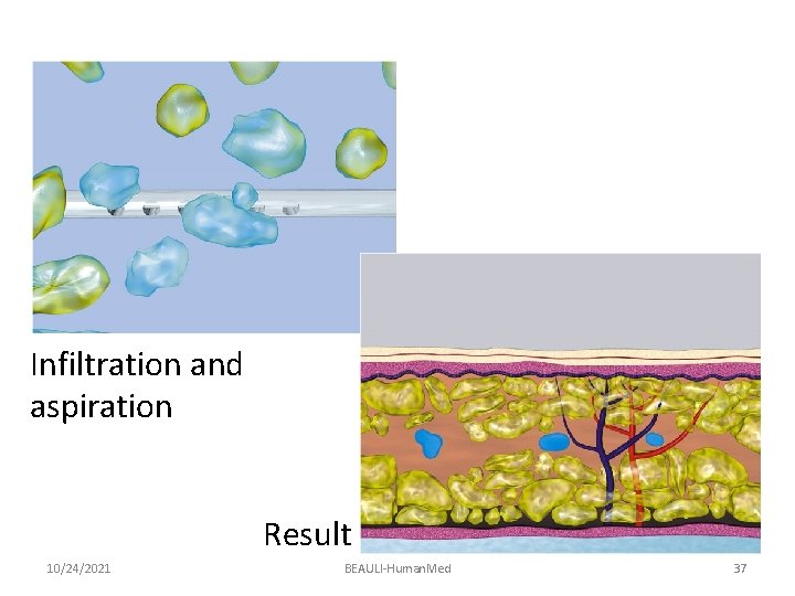Infiltration and aspiration Result 10/24/2021 BEAULI-Human. Med 37 
