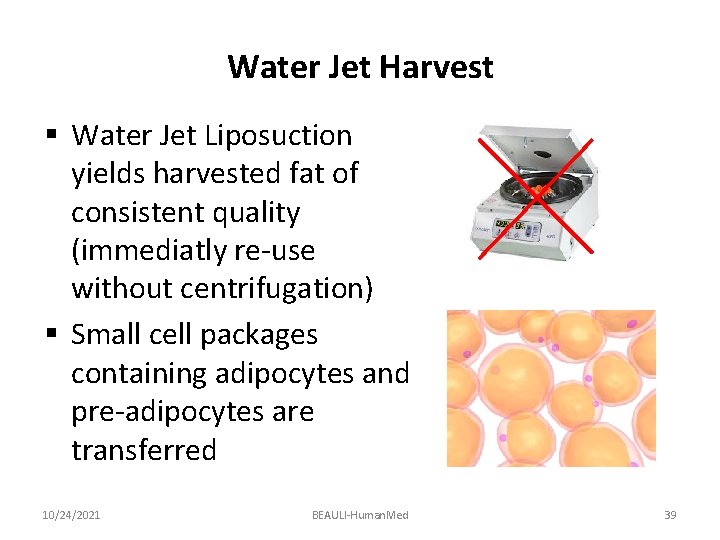 Water Jet Harvest § Water Jet Liposuction yields harvested fat of consistent quality (immediatly