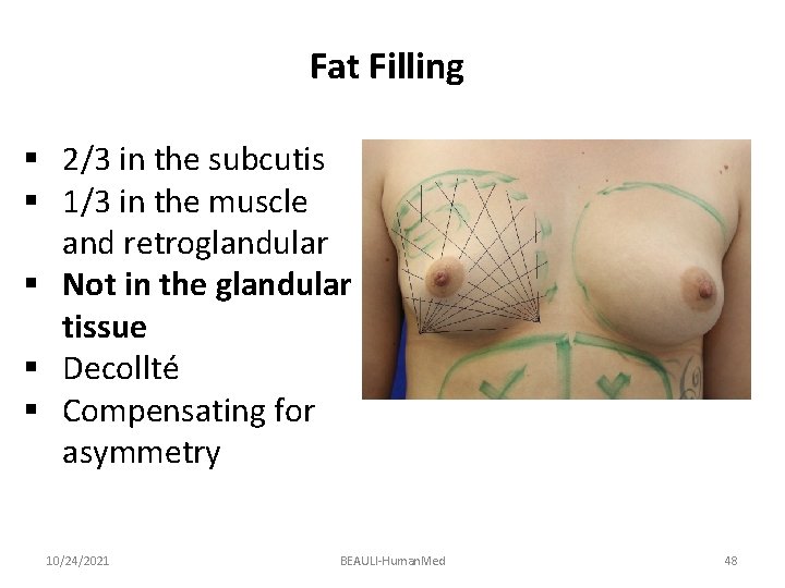 Fat Filling § 2/3 in the subcutis § 1/3 in the muscle and retroglandular
