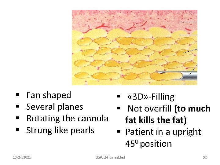§ § Fan shaped § « 3 D» -Filling Several planes § Not overfill