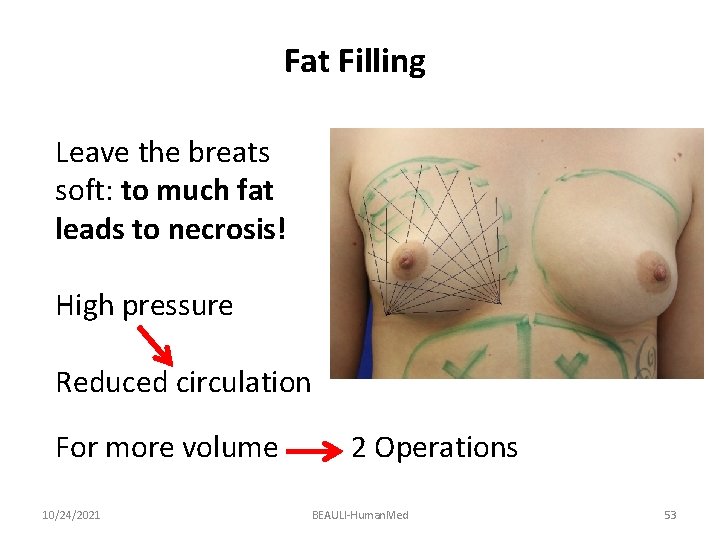 Fat Filling Leave the breats soft: to much fat leads to necrosis! High pressure