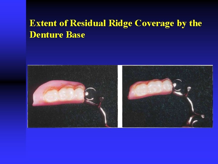 Extent of Residual Ridge Coverage by the Denture Base 