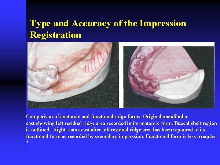 Type and Accuracy of the Impression Registration Comparison of anatomic and functional ridge forms.
