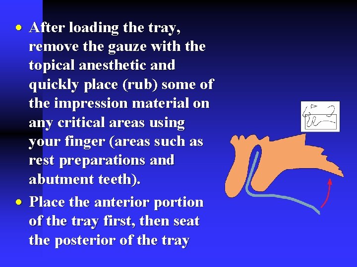 · After loading the tray, remove the gauze with the topical anesthetic and quickly