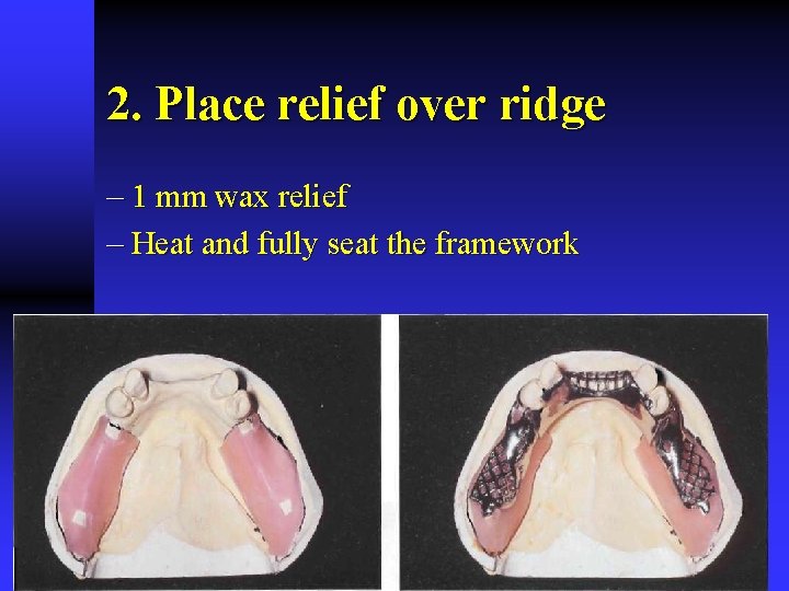 2. Place relief over ridge - 1 mm wax relief - Heat and fully
