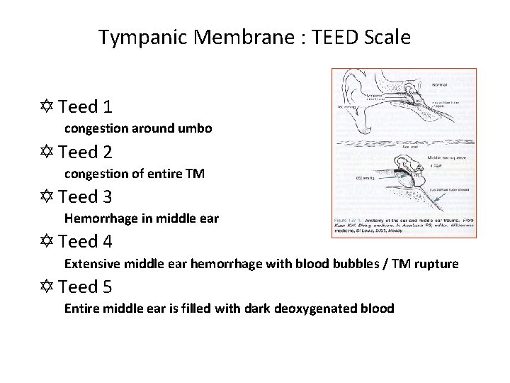 Tympanic Membrane : TEED Scale Y Teed 1 congestion around umbo Y Teed 2