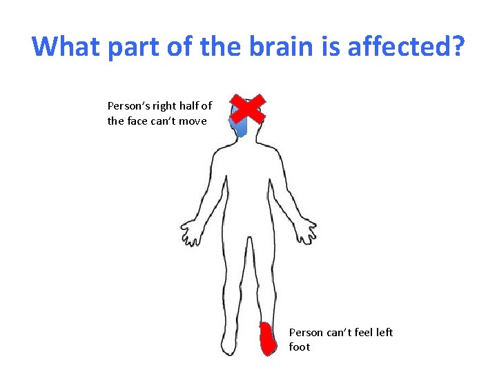 What part of the brain is affected? Person’s right half of the face can’t