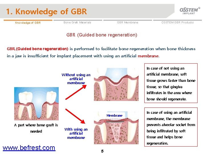 1. Knowledge of GBR OSSTEM GBR Products GBR Membrane Bone Graft Materials GBR (Guided