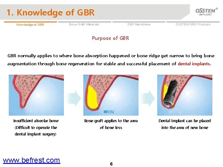 1. Knowledge of GBR GBR Membrane Bone Graft Materials OSSTEM GBR Products Purpose of