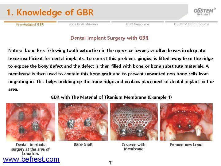 1. Knowledge of GBR OSSTEM GBR Products GBR Membrane Bone Graft Materials Knowledge of