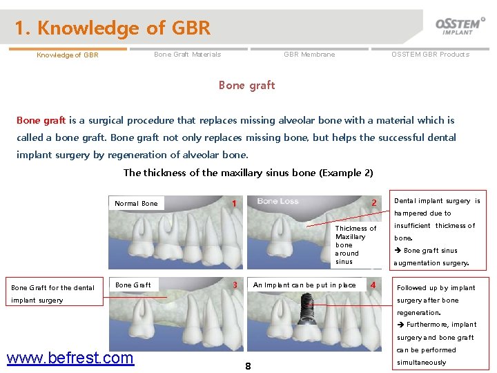 1. Knowledge of GBR OSSTEM GBR Products GBR Membrane Bone Graft Materials Knowledge of