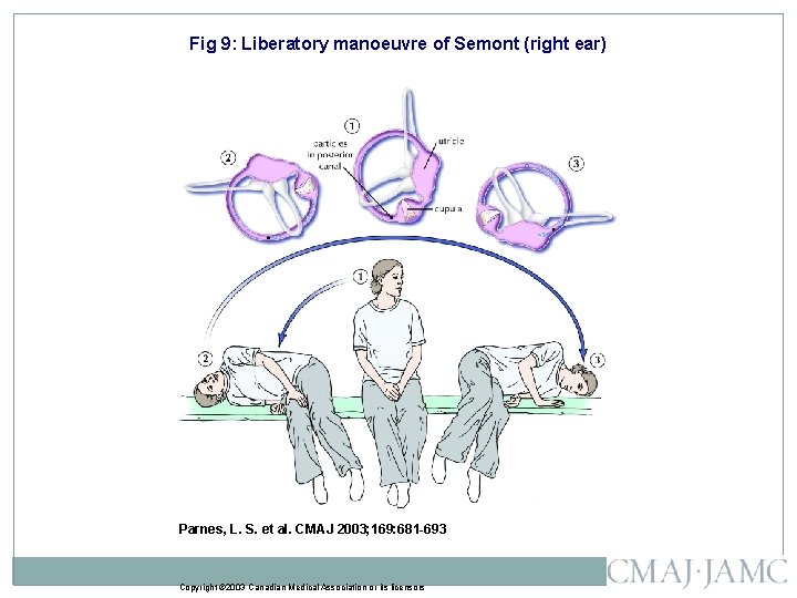 Fig 9: Liberatory manoeuvre of Semont (right ear) Parnes, L. S. et al. CMAJ