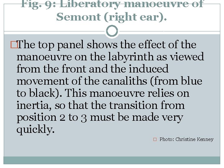 Fig. 9: Liberatory manoeuvre of Semont (right ear). �The top panel shows the effect