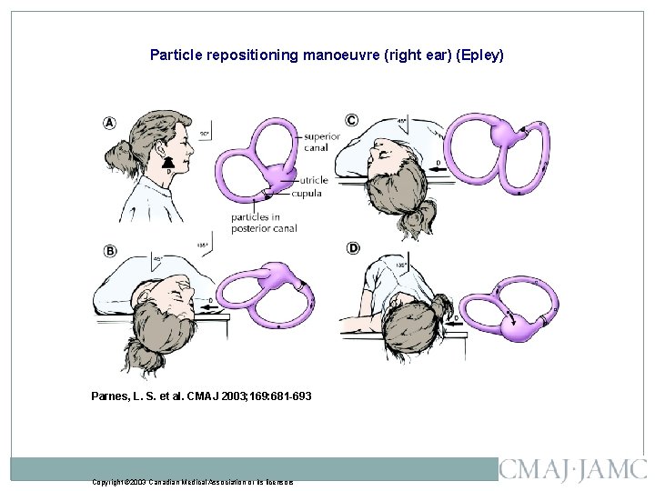 Particle repositioning manoeuvre (right ear) (Epley) Parnes, L. S. et al. CMAJ 2003; 169: