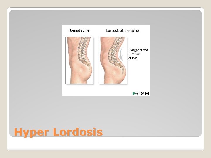 Hyper Lordosis 