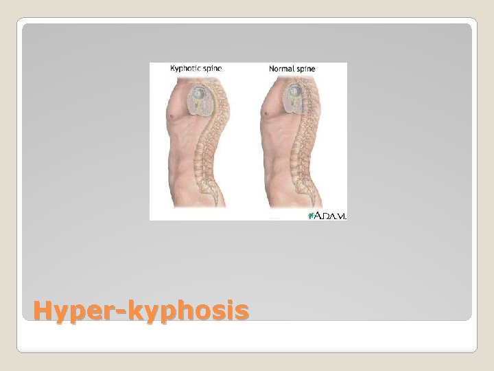 Hyper-kyphosis 