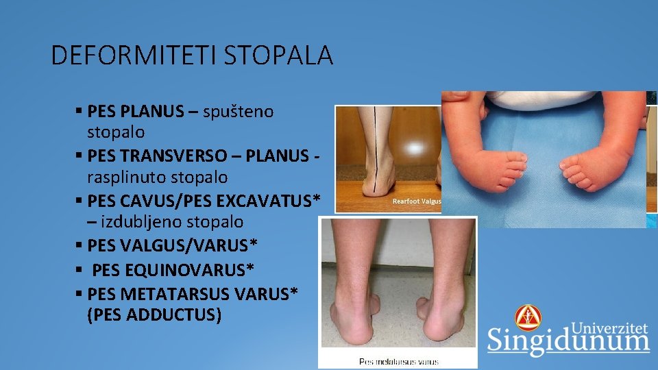 DEFORMITETI STOPALA § PES PLANUS – spušteno stopalo § PES TRANSVERSO – PLANUS rasplinuto