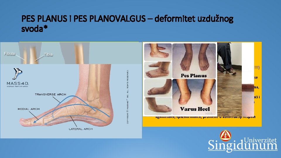 PES PLANUS i PES PLANOVALGUS – deformitet uzdužnog svoda* § 1. najčešći stečeni stopala