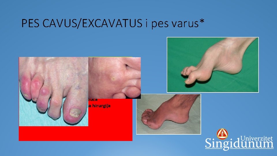 PES CAVUS/EXCAVATUS i pes varus* § naglašeno podignut medijalni uzdužni svod stopala 1. Bolni