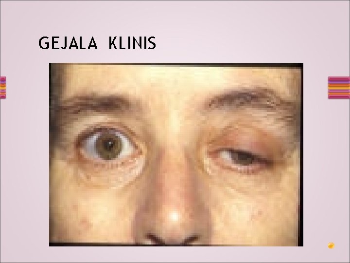 GEJALA KLINIS 