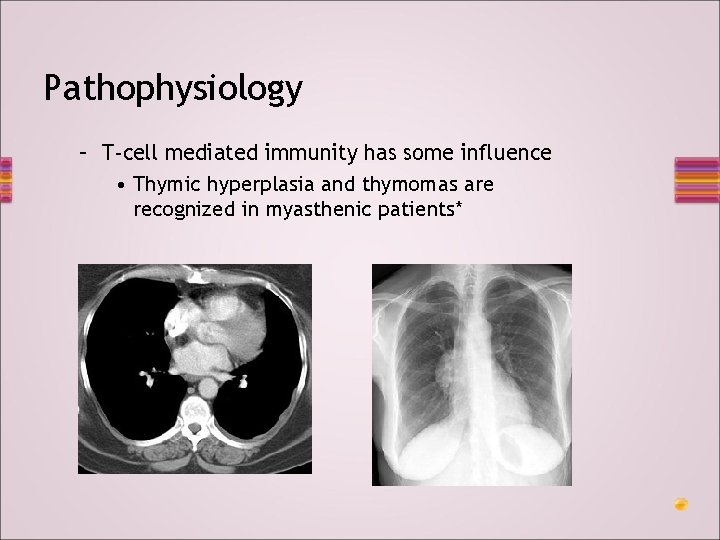 Pathophysiology – T-cell mediated immunity has some influence • Thymic hyperplasia and thymomas are