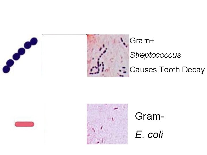 Gram+ Streptococcus Causes Tooth Decay Gram. E. coli 