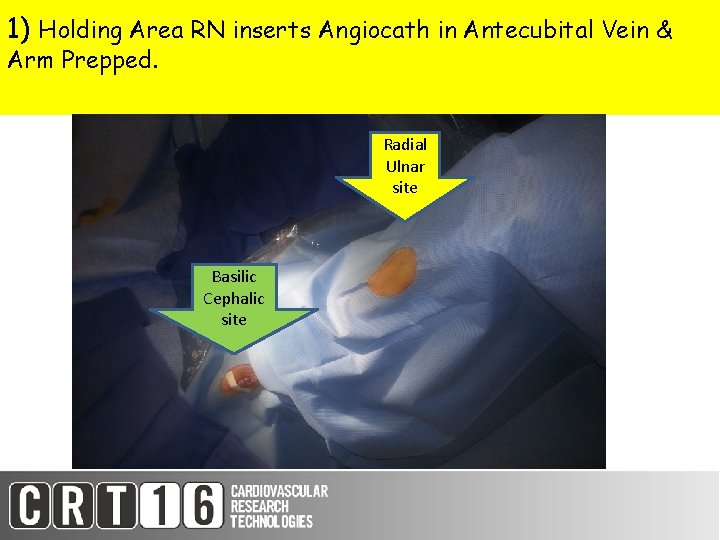 1) Holding Area RN inserts Angiocath in Antecubital Vein & Arm Prepped. Radial Ulnar