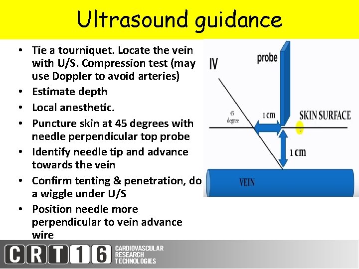 Ultrasound guidance • Tie a tourniquet. Locate the vein with U/S. Compression test (may
