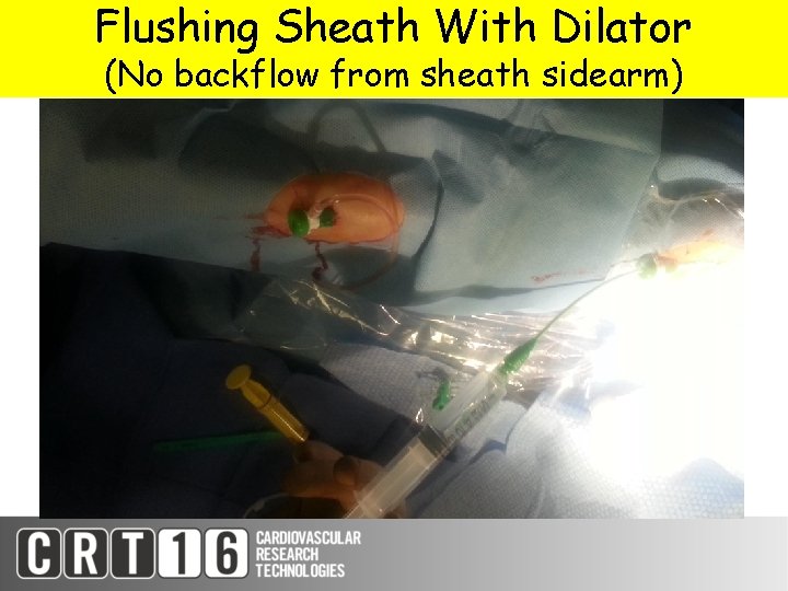 Flushing Sheath With Dilator (No backflow from sheath sidearm) 