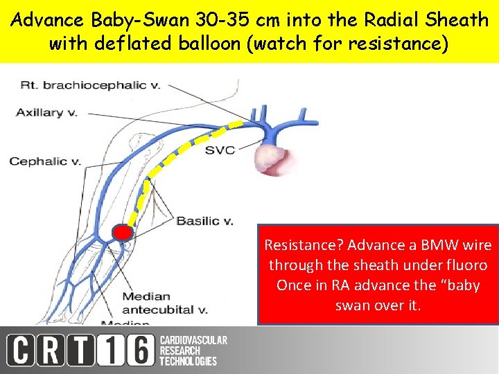 Advance Baby-Swan 30 -35 cm into the Radial Sheath with deflated balloon (watch for
