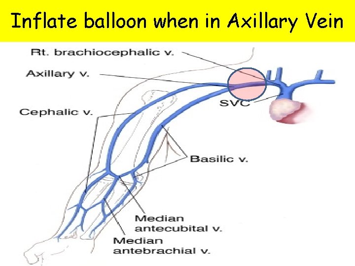 Inflate balloon when in Axillary Vein 